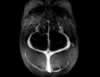 Sinus veineux- TOF- Image 22