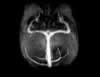 Sinus veineux- TOF- Image 24 de 24
